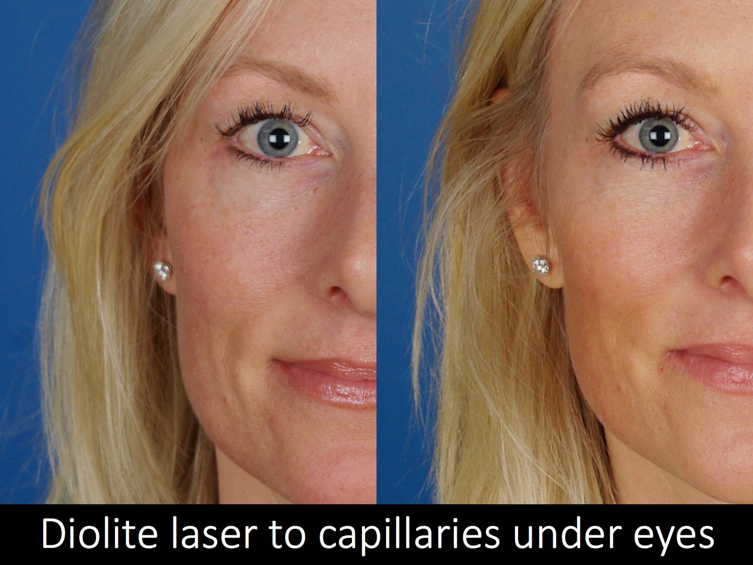 Laser Skin Treatments Before & Afters | Raval Facial Aesthetics | RMLA